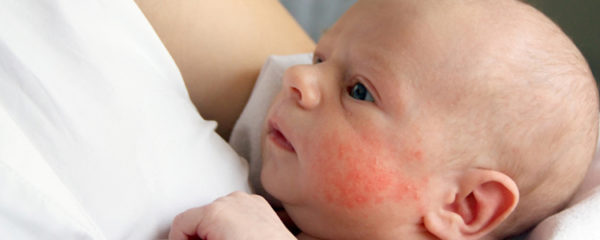 Eczéma de bébé